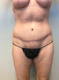 Abdominoplasty Case 10 After