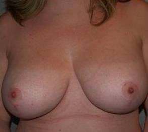 Breast Reduction Case 5 After