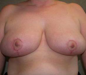 Breast Reduction Case 6 After