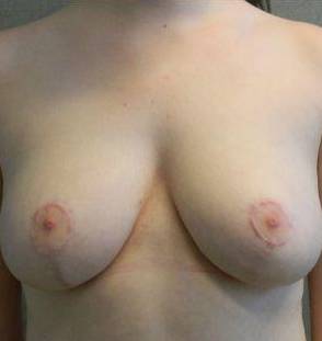Breast Reduction Case 7 After