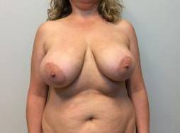 Breast Reduction Case 8 Before