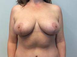 Breast Reduction Case 8 After