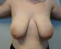 Breast Reduction Case 10 Before