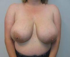 Breast Reduction Case 11 Before