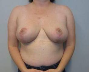 Breast Reduction Case 11 After