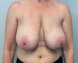 Breast Reduction Case 12 Before