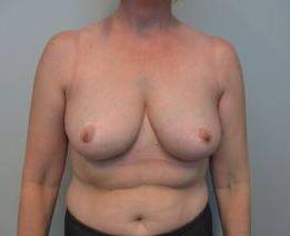 Breast Reduction Case 12 After