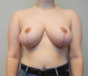 Breast Reduction Case 14 After