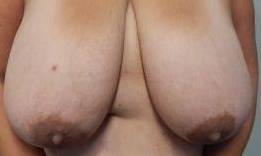 Breast Reduction Case 19 Before