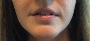 Dermal Filler Case 3 Before