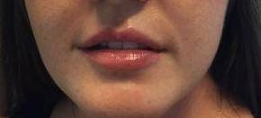 Dermal Filler Case 3 After