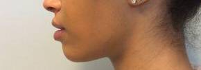 Dermal Filler Case 1 After