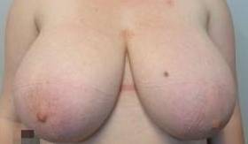 Breast Reduction Case 24 Before