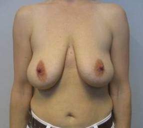 44yo Female Mastopexy Before