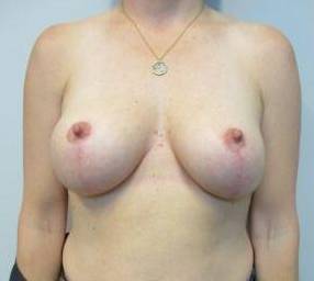 44yo Female Mastopexy After