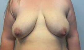 30yo Female Mastopexy w/ Augmentation Before