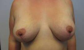 30yo Female Mastopexy w/ Augmentation After