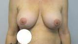 48yo Female Mastopexy w/ Augmentation After