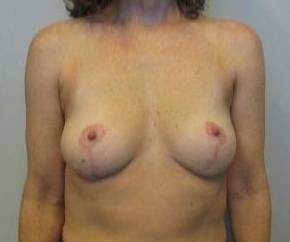 47yo Female Mastopexy After