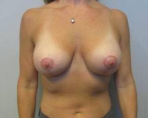44yo Female Mastopexy w/ Augmentation After