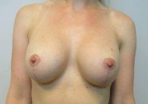 36yo Female Mastopexy w/ Augmentation After