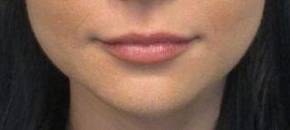 Dermal Filler Case 6 Before