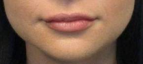 Dermal Filler Case 6 After