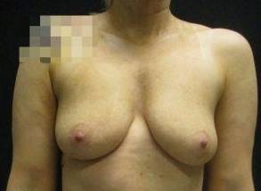 35yo Female Mastopexy w/ Augmentation Before
