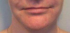 Dermal Filler Case 5 Before