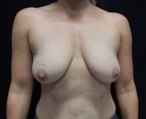 39yo Female Mastopexy w/ Augmentation Before