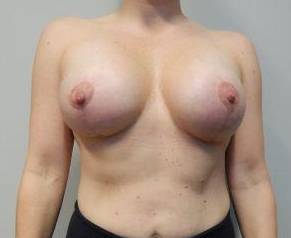 39yo Female Mastopexy w/ Augmentation After