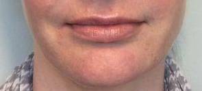 Dermal Filler Case 5 After