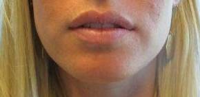 Dermal Filler Case 4 Before