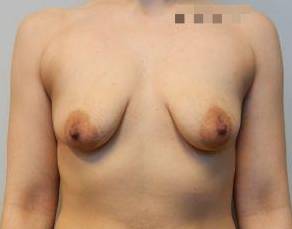 27yo Female Mastopexy w/ Augmentation Before