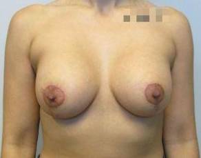 27yo Female Mastopexy w/ Augmentation After