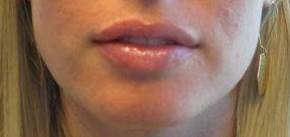 Dermal Filler Case 4 After