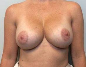 46yo Female Mastopexy w/ Augmentation Before