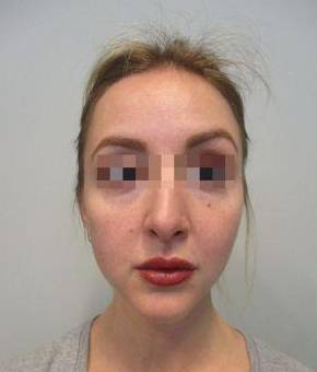 Dermal Filler Case 2 Before