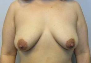 34yo Female Mastopexy w/ Augmentation Before