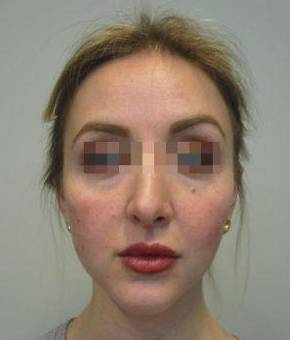 Dermal Filler Case 2 After