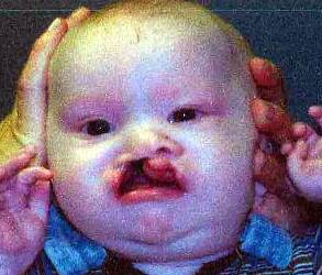 Cleft Lip and Palate Case 1 Before