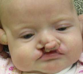 Cleft Lip and Palate Case 2 Before