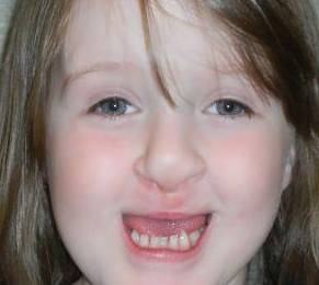Cleft Lip and Palate Case 2 After