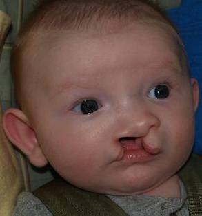 Cleft Lip and Palate Case 3 Before