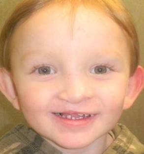 Cleft Lip and Palate Case 3 After