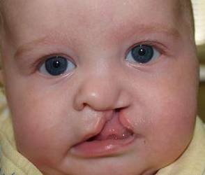 Cleft Lip and Palate Case 4 Before