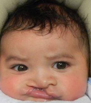 Cleft Lip and Palate Case 6 Before