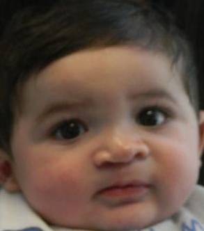 Cleft Lip and Palate Case 6 After