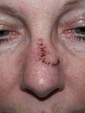 Skin Cancer Case 1 Before