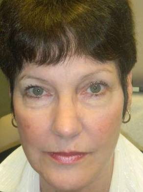 Skin Cancer Case 1 After